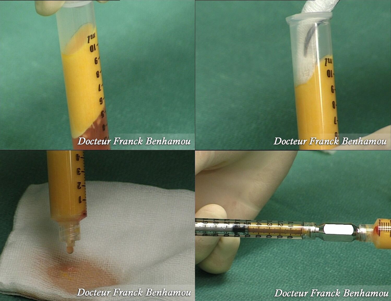 Technique d' injection de graisse dans les fesses