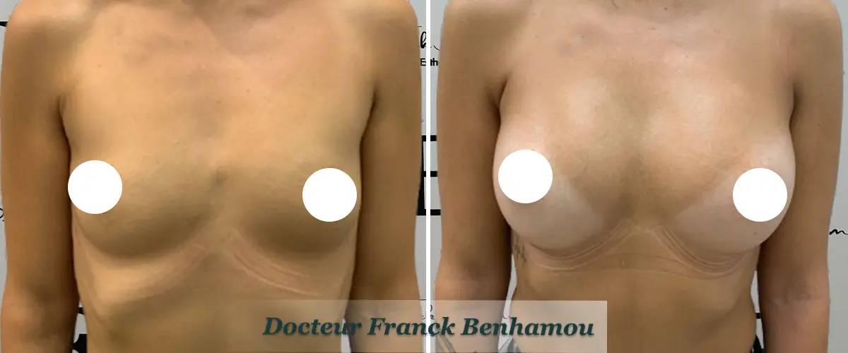 Photos avant après augmentation mammaire